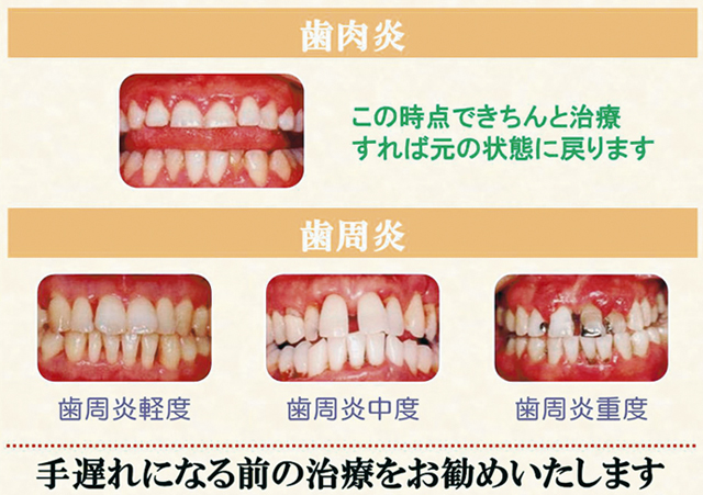 歯肉炎／歯周炎